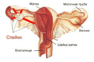 Воспаление маточной трубы